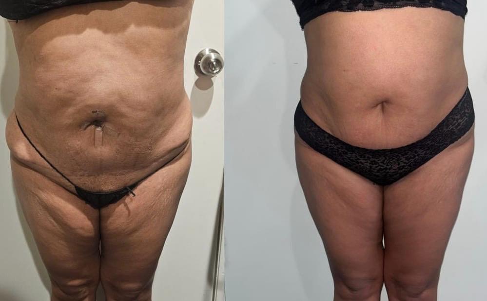 Before / After